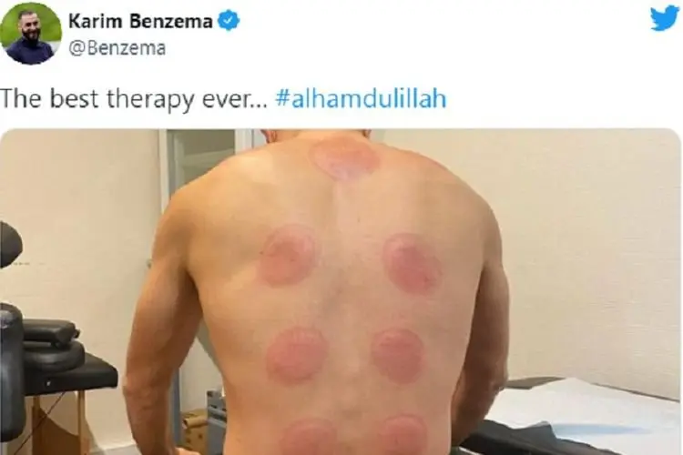 Alhamdulillah...Karim Benzema Dapatkan Terapi Terbaik yang Pernah Ada: Bekam!