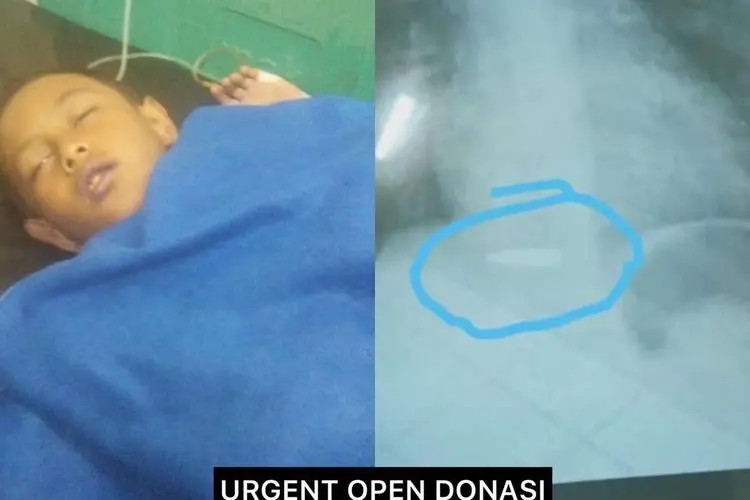 Bocah di Bandung Barat Terkena Peluru Nyasar, Begini Kondisinya Usai Jalani Operasi