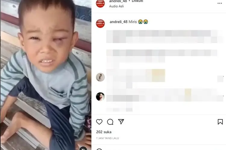 Diduga Disiksa Ayah Tirinya, Mata Bocah Laki-laki Ini Terlihat Lebam Sampai Tak Bisa Dibuka
