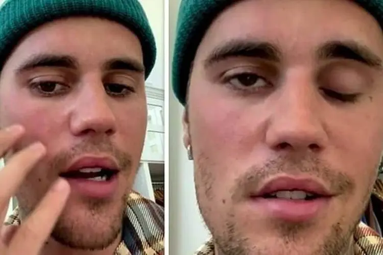 Justin Bieber Alami Kelumpuhan di Wajah, Gagal Konser di Jakarta?
