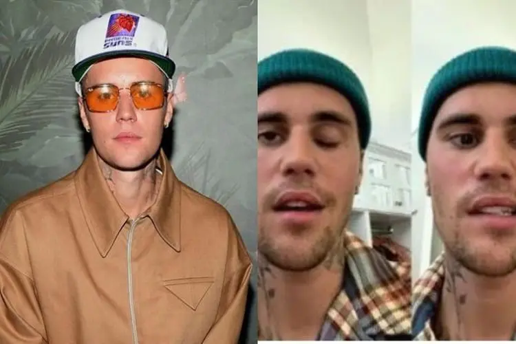 Justin Bieber Derita Sindrom Ramsay Hunt hingga Buat Separuh Wajahnya Lumpuh, Apa Itu?