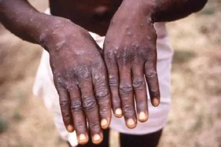 Afrika Butuh Alat Tes dan Vaksin Lantaran Cacar Monyet Menyebar