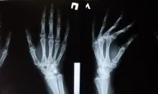 Menjaga Tulang Sejak Dini Mencegah Osteoporosis