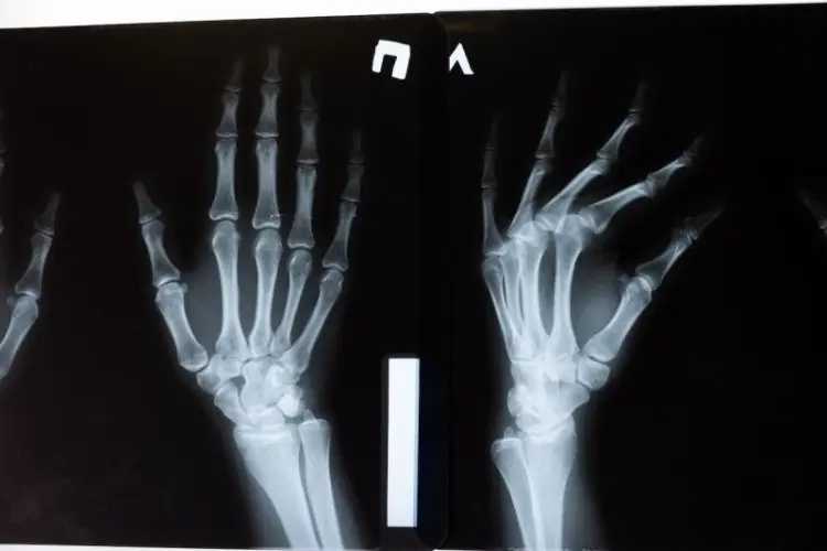 Menjaga Tulang Sejak Dini Mencegah Osteoporosis