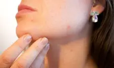 Jerawat Menyerang? Tenang, 7 Skincare Andalan Berbahan Tea Tree Ini Siap Jadi Pahlawan Kulitmu!