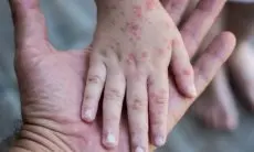 Tetap Waspada... Data Kemenkes RI: Monkeypox Sudah Jangkit 27 Orang