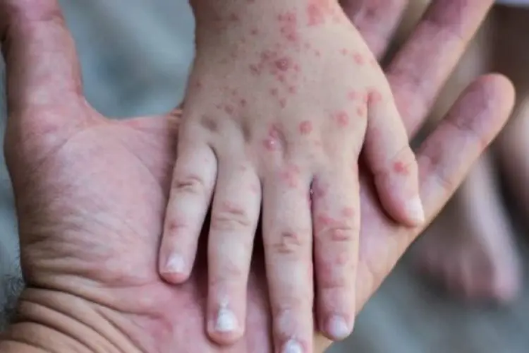 Tetap Waspada... Data Kemenkes RI: Monkeypox Sudah Jangkit 27 Orang