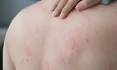 Jangan Disepelekan! Ketahui Penyebab Umum dan Cara Obati Biang Keringat