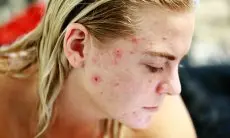 Jerawat Mendadak Muncul? Atasi dengan Kandungan Skincare Ini!