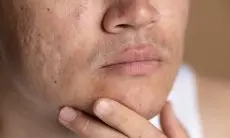 6 Obat Rumahan yang Bisa Bantu Kecilkan Pori-pori Secara Alami