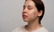 4 Manfaat Ajaib Witch Hazel untuk Atasi Jerawat yang Membandel