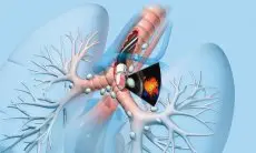 Mengenal Teknologi Endobronchial Ultrasound (EBUS) untuk Deteksi Kanker Paru