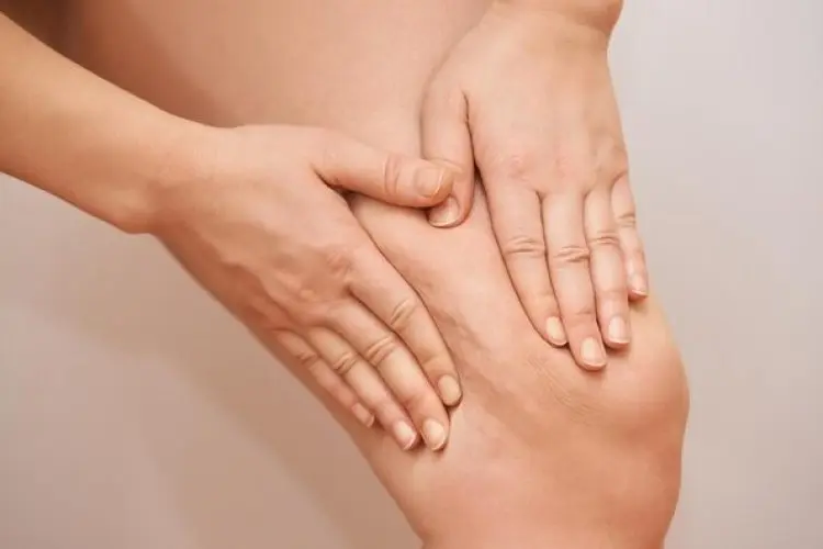 Tips Menghilangkan Selulit, Ahli Ungkap 3 Bahan Alami untuk Mengatasinya