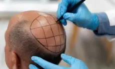 Tren di Kalangan Artis, Ini yang Perlu Diketahui Sebelum Lakukan Transplantasi Rambut