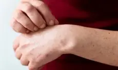 Tips Mudah Obati Ruam Pada Kulit agar Tidak Semakin Parah, Salah Satunya Jangan Digaruk!