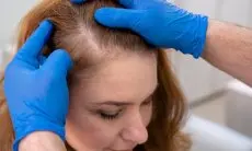 Cegah Rontok dan Kebotakan, Inilah 5 Vitamin untuk Percepat Pertumbuhan Rambut