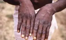 Pemprov Jabar Terus Pantau Ancaman Monkeypox