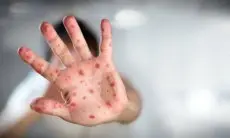 Dinkes Kota Cimahi Minta Warganya Segera Datangi Faskes Jika Merasakan Gejala Cacar Monyet ini