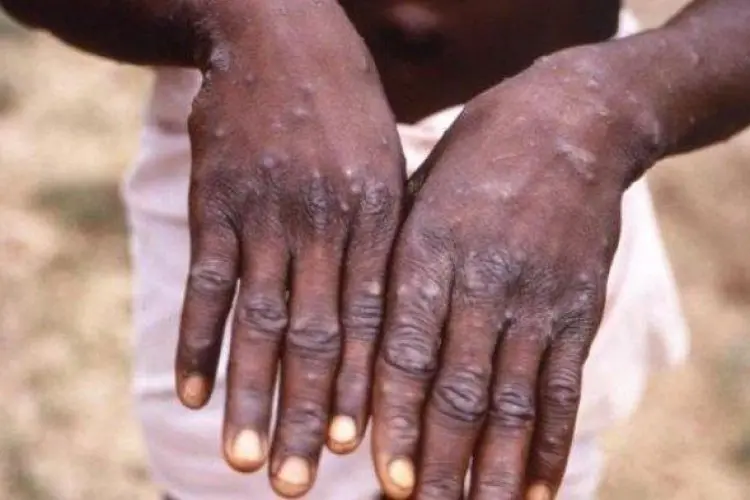 Pemprov Jabar Terus Pantau Ancaman Monkeypox