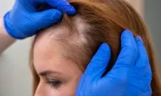 Gejala Kekurangan Zat Besi, Tanda-tanda Kerontokan Rambut yang Perlu Diwaspadai