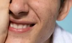 Rahasia Kulit Mulus: Cara Mengatasi Whiteheads di Hidung!