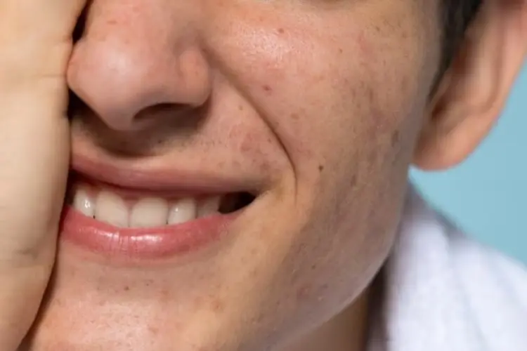 Rahasia Kulit Mulus: Cara Mengatasi Whiteheads di Hidung!