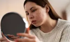 Tips Jitu Memilih Skincare yang Tepat untuk Kulit Berjerawat
