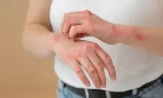 Pengobatan Alami, 6 Minyak Esensial yang Bisa Membantu Mengatasi Psoriasis