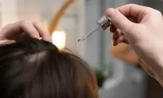 5 Minyak Alami untuk Ketombe: Pilihan Terbaik untuk Rambut Bersih dan Sehat