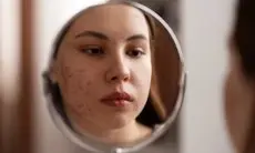 Cara Memilih Serum untuk Kulit Berjerawat, Simak Tips dan Manfaatnya Disini