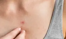 Cara Ampuh Mengatasi Jerawat di Dada dan Penyebabnya