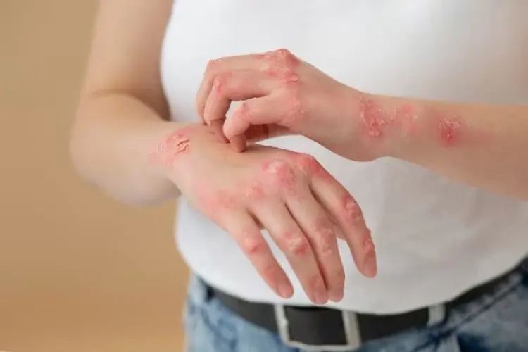 Pengobatan Alami, 6 Minyak Esensial yang Bisa Membantu Mengatasi Psoriasis