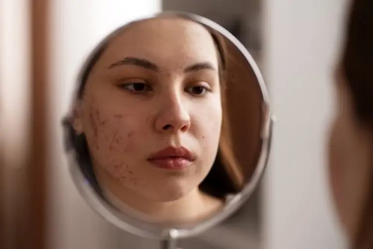 Cara Memilih Serum untuk Kulit Berjerawat, Simak Tips dan Manfaatnya Disini