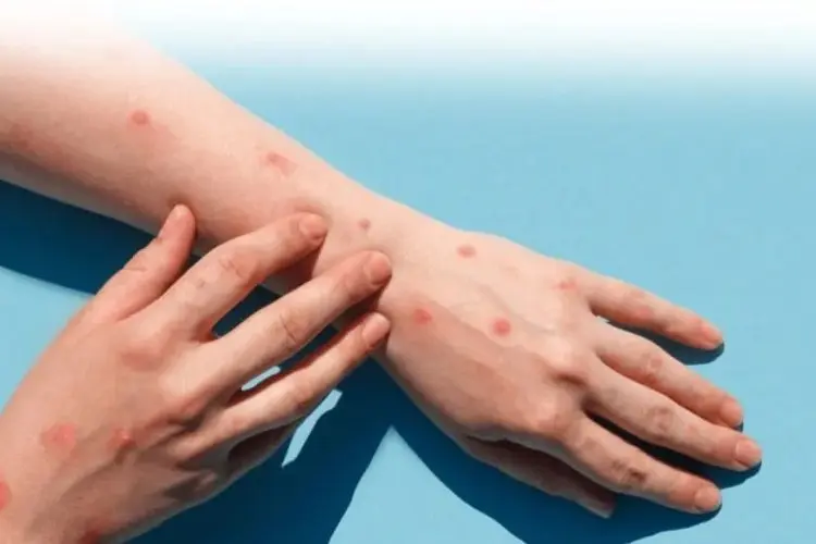 Cacar Air Bikin Gatal? Tenang! 5 Ramuan Alami Ini Bikin Bekas Cacar Cepat Pudar dan Kulit Segar Kembali