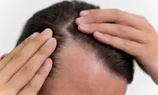 Garis Rambut Mundur? Ini Cara Mengembalikan Kepercayaan Diri Anda