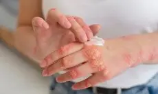 Kulit Gatal Selama Musim Hujan, Simak Penyebab dan Solusi untuk Mengatasinya
