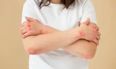 Penting! Cara Melindungi Kulit dengan Eczema di Musim Hujan