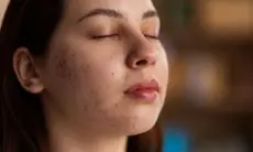 7 Herbal yang Bisa Atasi Jerawat dengan Ampuh