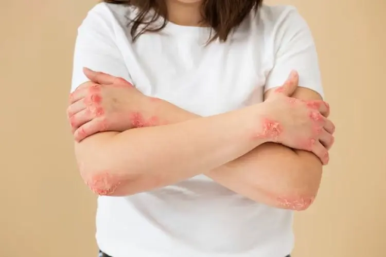 Penting! Cara Melindungi Kulit dengan Eczema di Musim Hujan