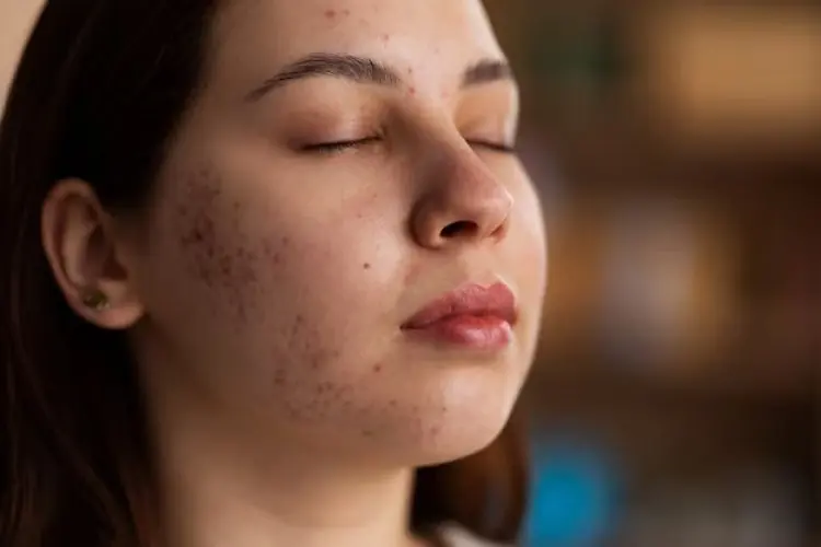 7 Herbal yang Bisa Atasi Jerawat dengan Ampuh
