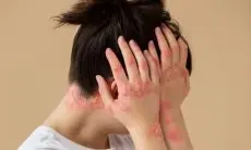 Dermatitis Seboroik: Kondisi Kulit Gatal dan Bersisik yang Perlu Anda Ketahui