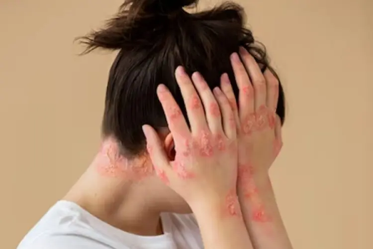 Dermatitis Seboroik: Kondisi Kulit Gatal dan Bersisik yang Perlu Anda Ketahui