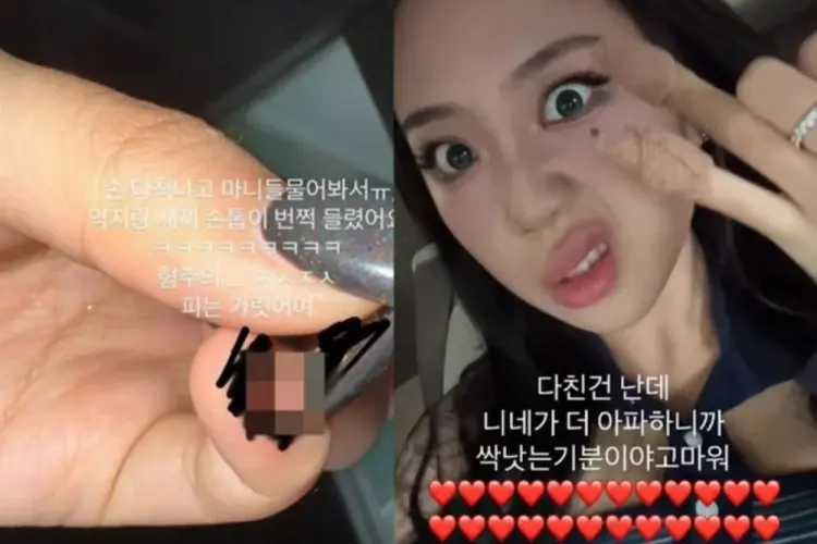 Unggah Foto Cedera Kuku, Lee Young Ji Malah Kehilangan 4.000 Followers Instagram