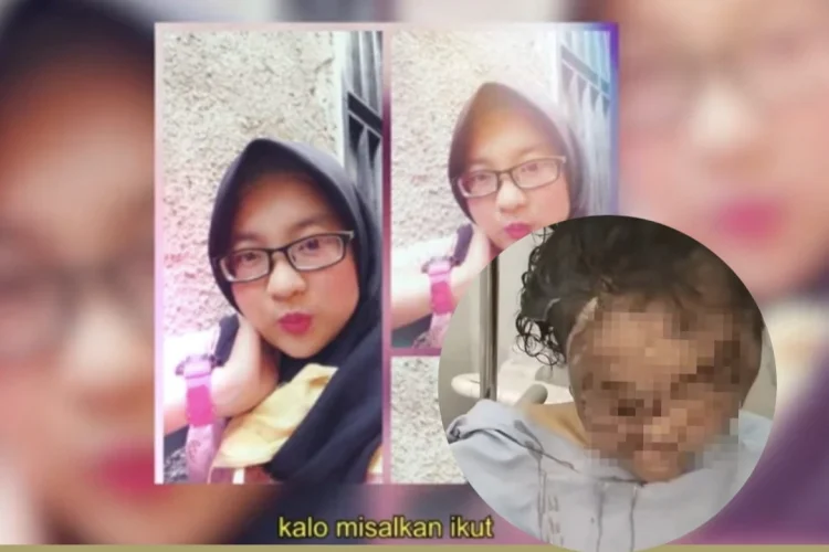 Kondisi Yuvita Terkini, RSHS Ungkap Rencana Rekonstruksi Wajah