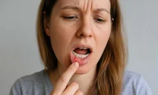 Sariawan Sering Kambuh? Waspadai Kekurangan Vitamin hingga Tanda Penyakit Serius