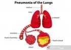 Yuk Kenali Gejala Tak Khas Pneumonia pada Lansia