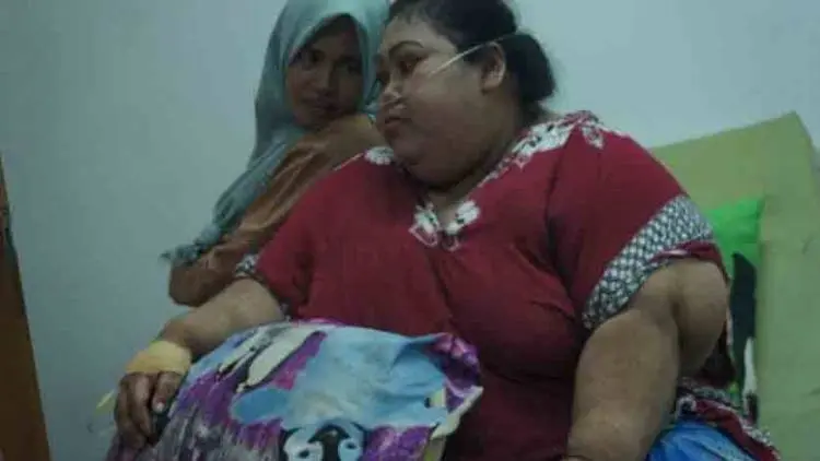 Pasien Obesitas Asal Karawang Alami Gangguan Liver