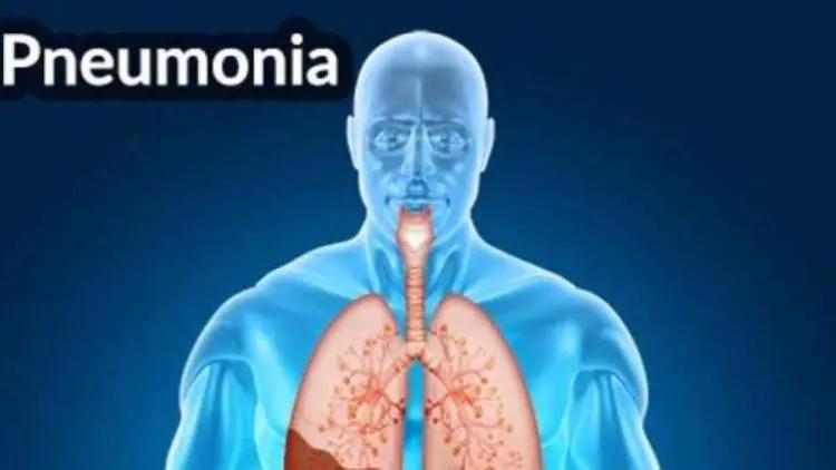 Mengenal Lebih Dekat Pneumonia