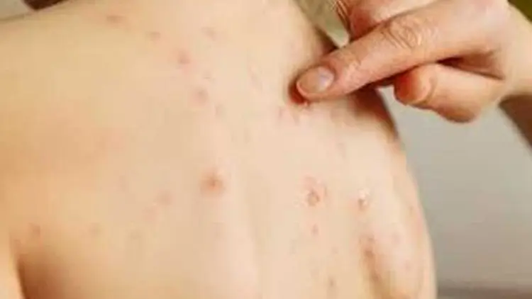 Penyakit Monkeypox Belum Pernah Dilaporkan Terjadi di Indonesia
