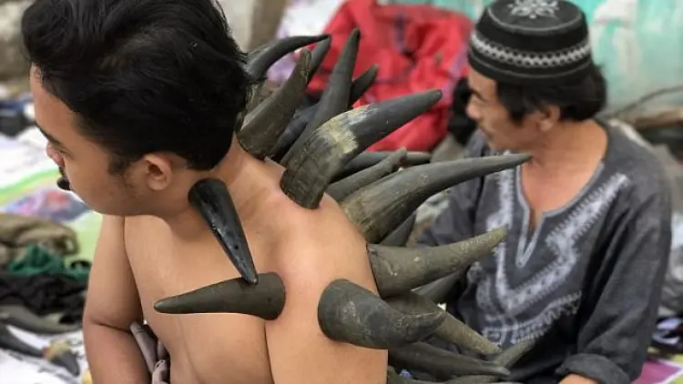 Bekam Tanduk Masih Menjadi Pilihan Pengobatan
